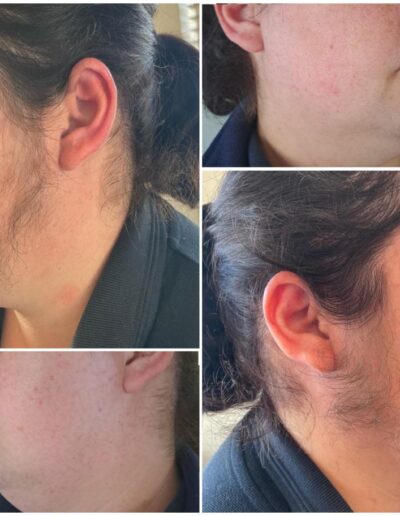 Spa at Banksia - Facial Hair Removal
