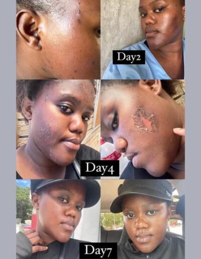 Skinworks Studio - Algae Peel Day 1 to 7