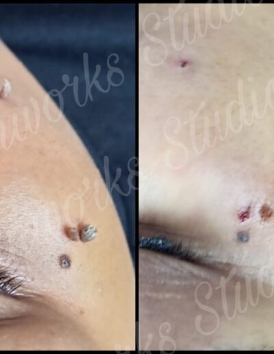 Skinworks Studio - Skin tag removal