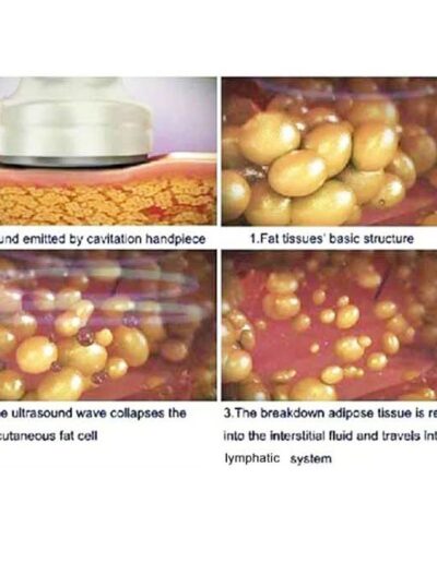 Skinworks Studio - Ultrasound Cavitation