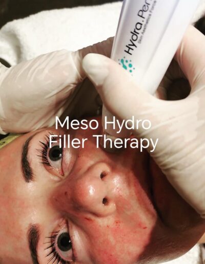 Butterfly Effect Beauty - Meso Hydro Filler Therapy
