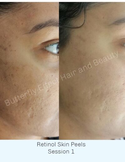 Butterfly Effect Beauty - Retinol Skin Peels - Before and After