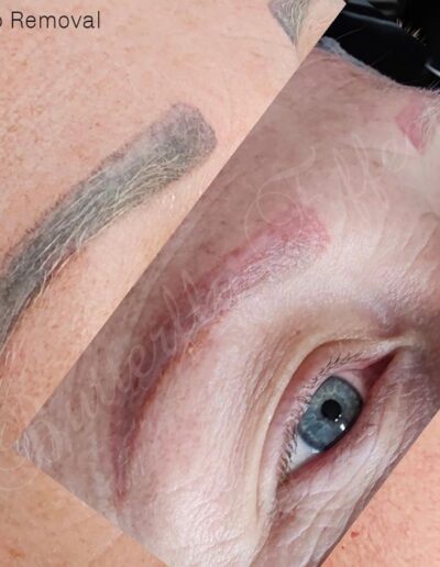 Butterfly Effect Beauty - Tattoo Removal - Before and