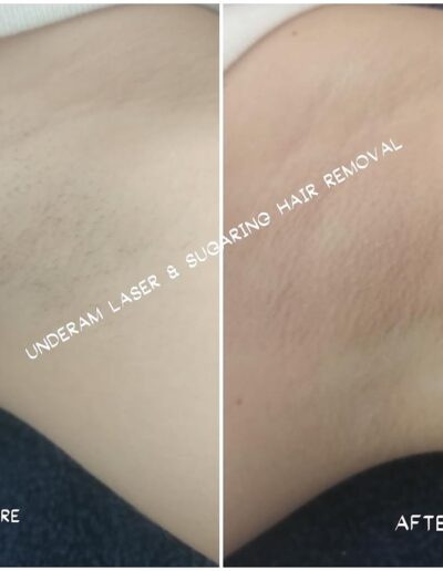 Butterfly Effect Beauty - Underarm Laser and Sugaring Hair Removal - Before and After