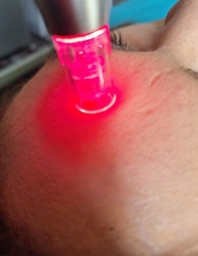 PDT - Photon Dynamic Therapy - Microneedling