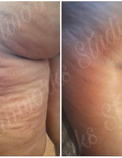 Skinworkds Studio - Before and After cellulite treatmen
