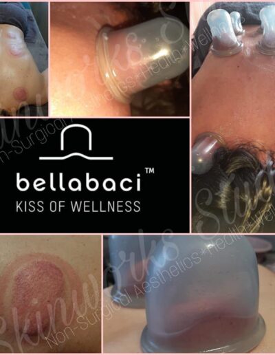 Skinworkds Studio - Bellabaci suction treatment