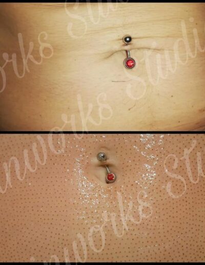 Skinworkds Studio - Plasma Fibroblast Skin Tightening