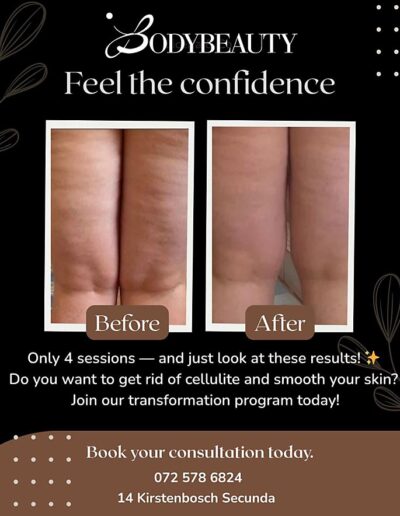 BodyBeauty BodySculpting - Get rid of cellulite - before and after a