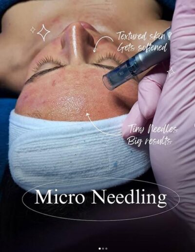 Synergy Skin and Body Studio - Microneedling - softer texture - tiny needles big results