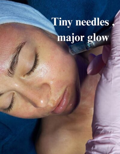 Synergy Skin and Body Studio - Tiny needles major glow