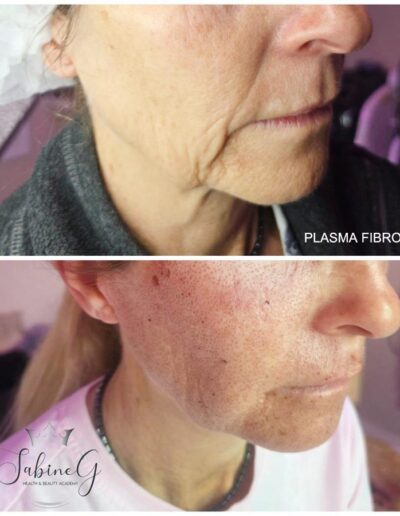 SabineG Health and Beauty Academy - Plasma Fibroblast