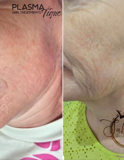 SabineG Health and Beauty Academy - Plasma Skin
