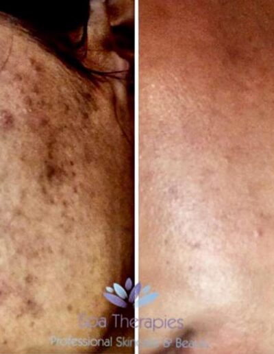 Professional Skin Peels - Before and After skin pigmentation