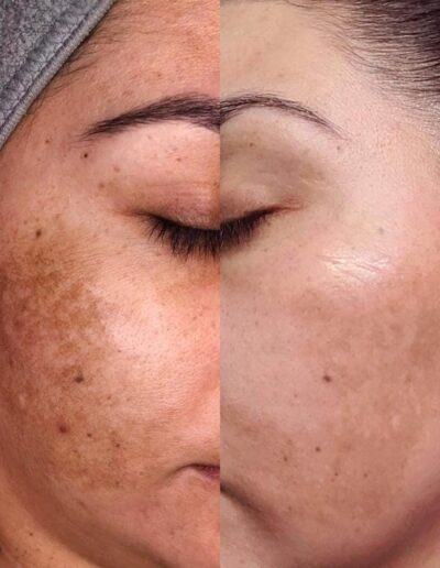 Professional Skin Peels - Before and After skin pigmentation