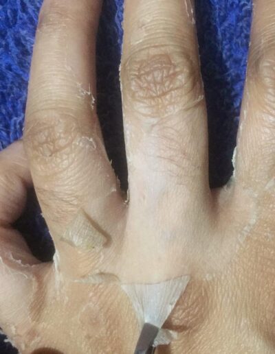 Professional Skin Peels - Hands